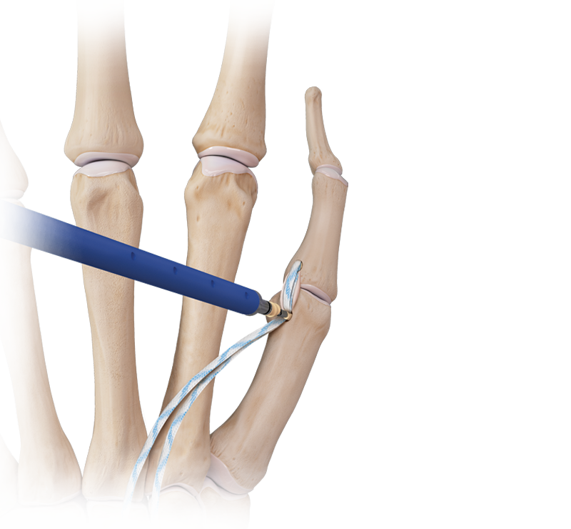Arthrex - Hand/Wrist InternalBrace™ Ligament Augmentation Repair